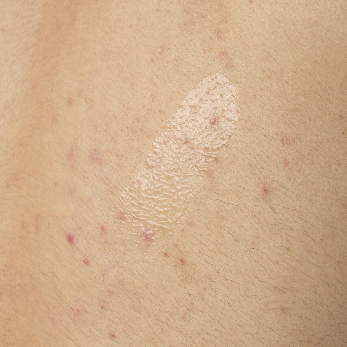 salicylic-acid-0-5-body-serum-m2 ORD-salicylic-acid-05-body-240ml-application.jpg