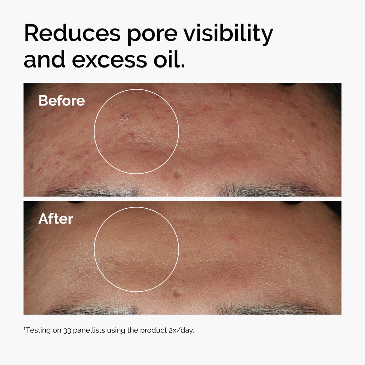niacinamide-10-zinc-1-h7 ord-niacinamide-zinc-blemish-serum-before-after-pores.jpg