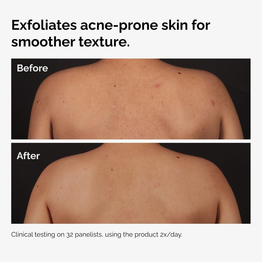 the-body-care-collection-s4 ord-salicylic-acid-body-serum-before-after-graphic-NA.jpg