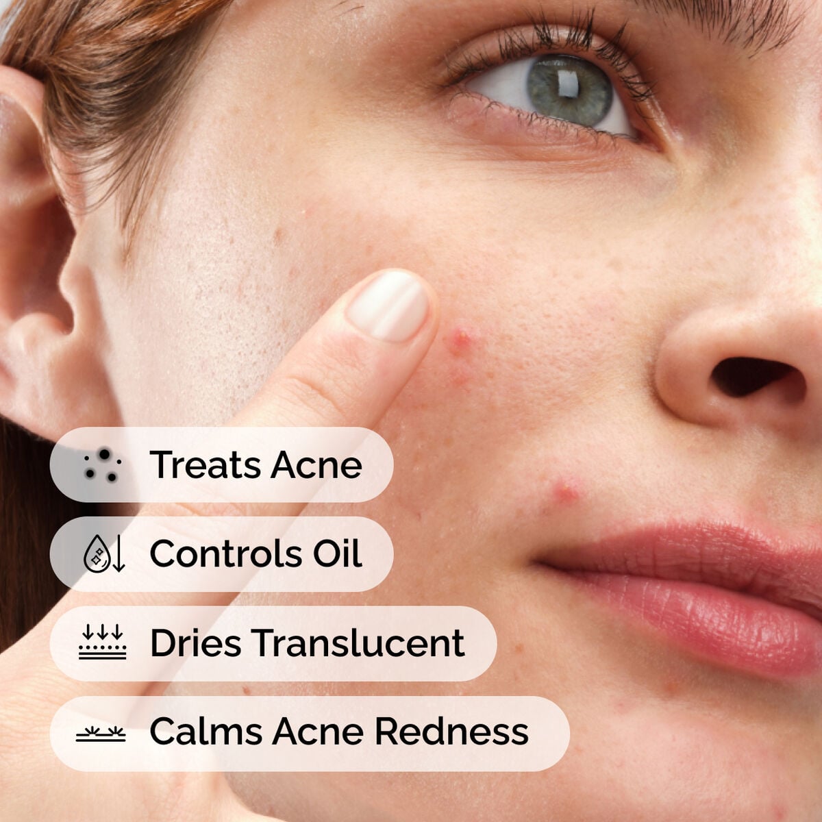 sulfur-10-powder-to-cream-concentrate-v8 ord-sulfur-10pct-powder-to-cream-concentrate-model-application-with-benefits-acne.jpg