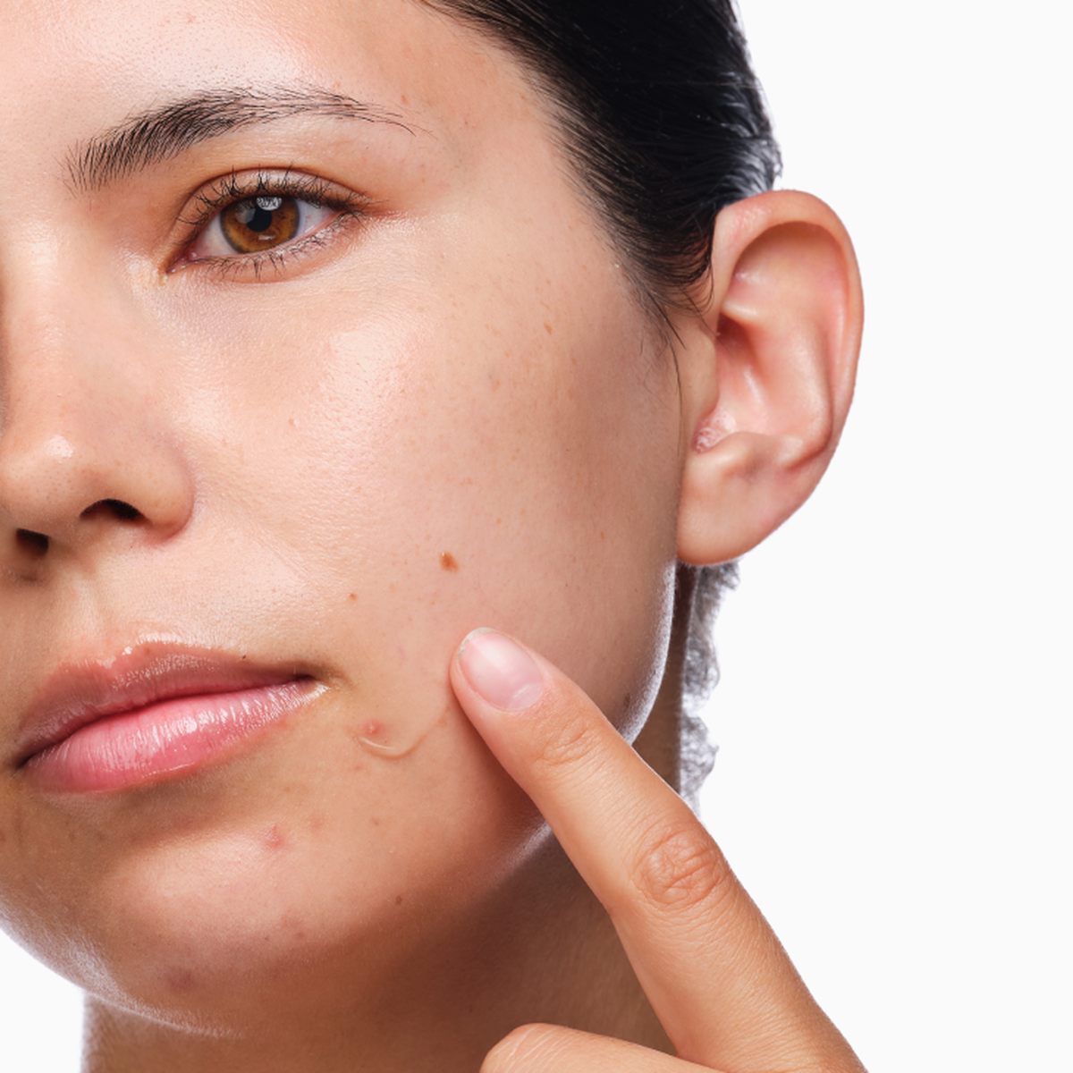 the-acne-set-q5 rdn-the-acne-set-application.png